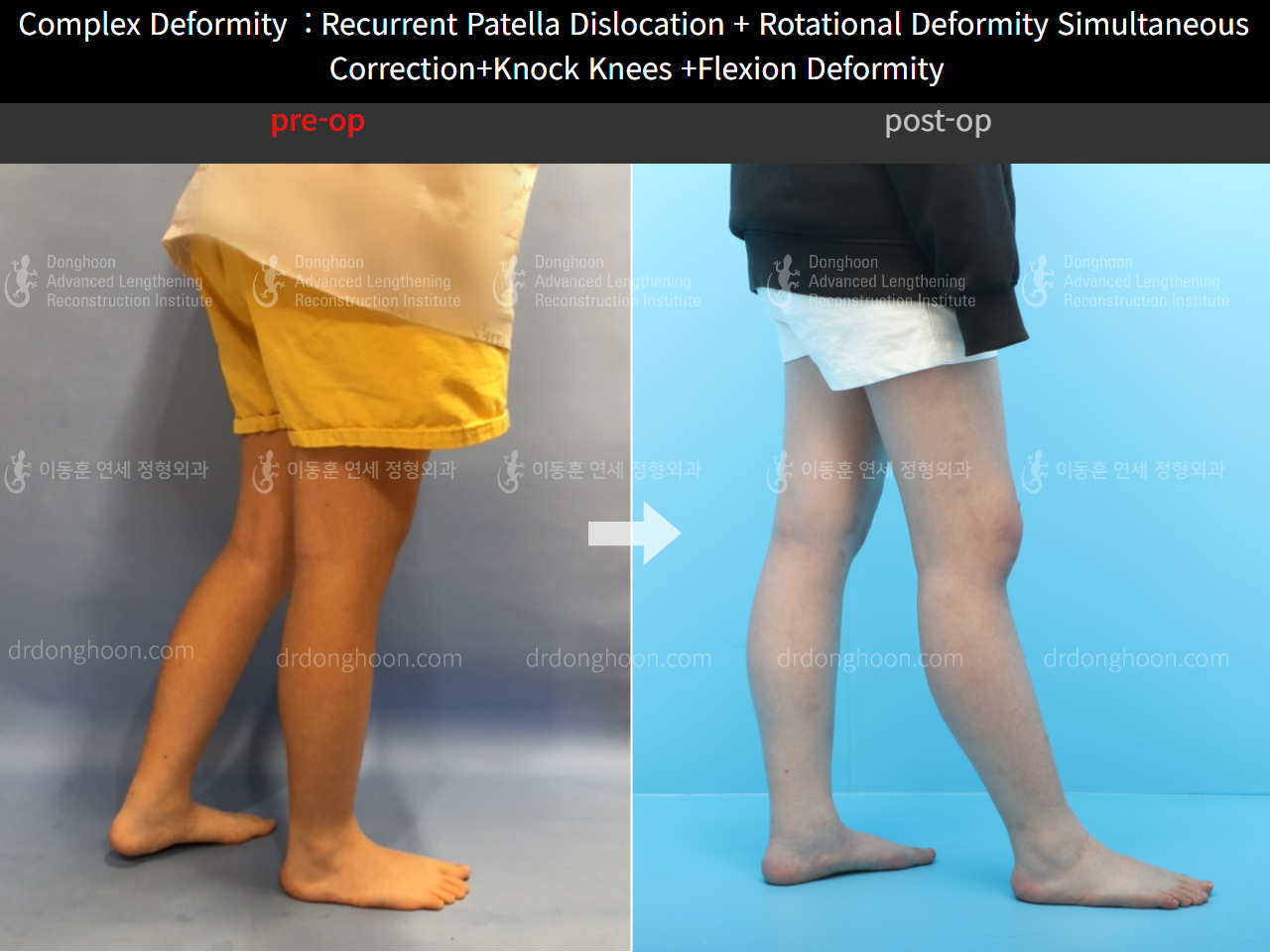 Before and after complex deformity, case 4251605, image 4, Dr. Donghoon institute (DALRI)