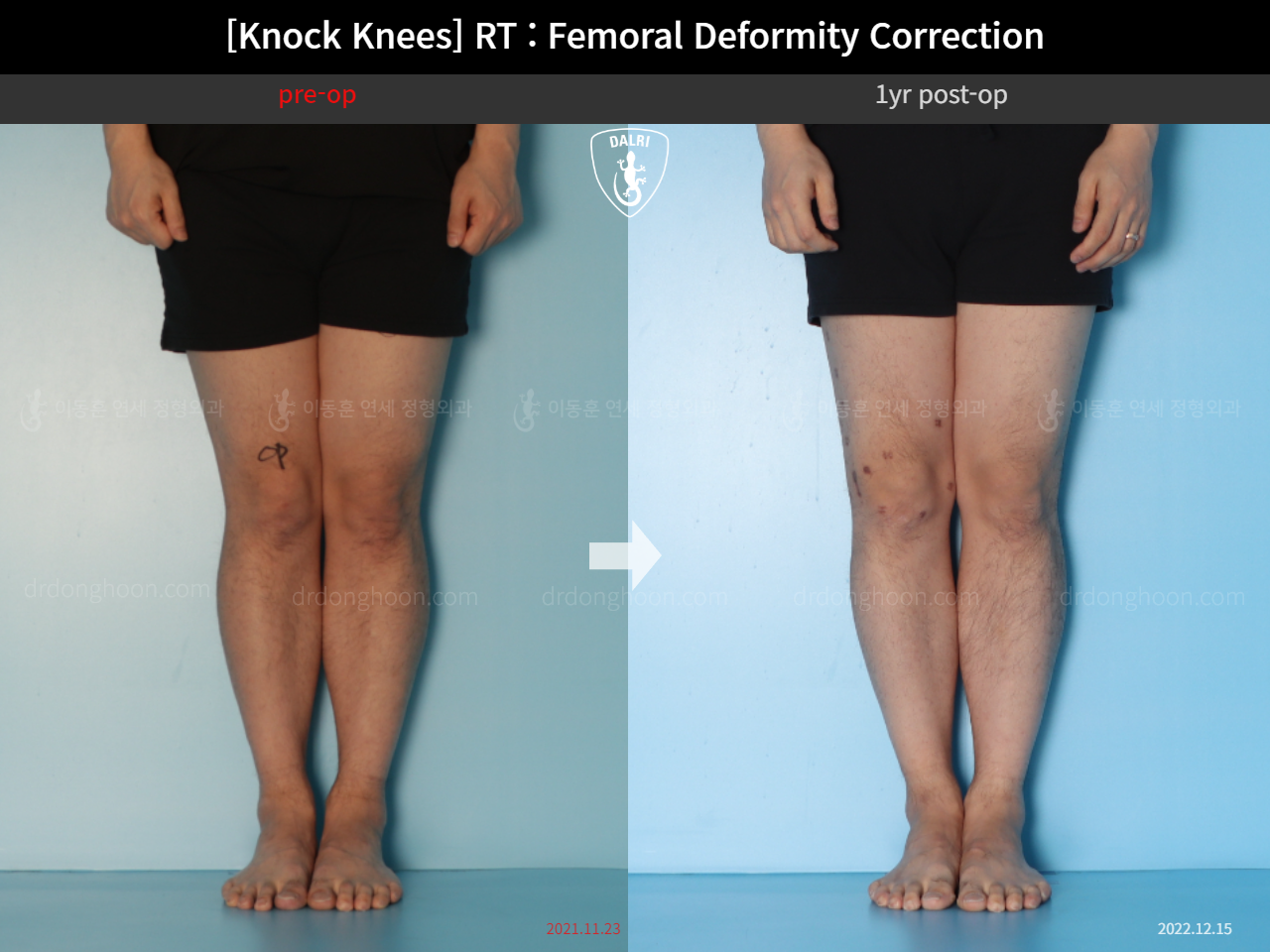 Before and after adult knock knees, case 15950751, image 9, Dr. Donghoon institute (DALRI)