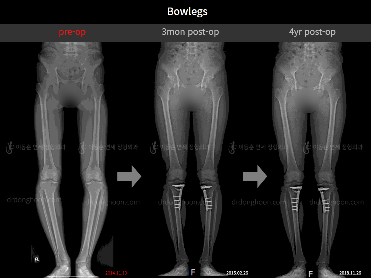 Before and after adult bowlegs, case 4311360, image 9, Dr. Donghoon institute (DALRI)