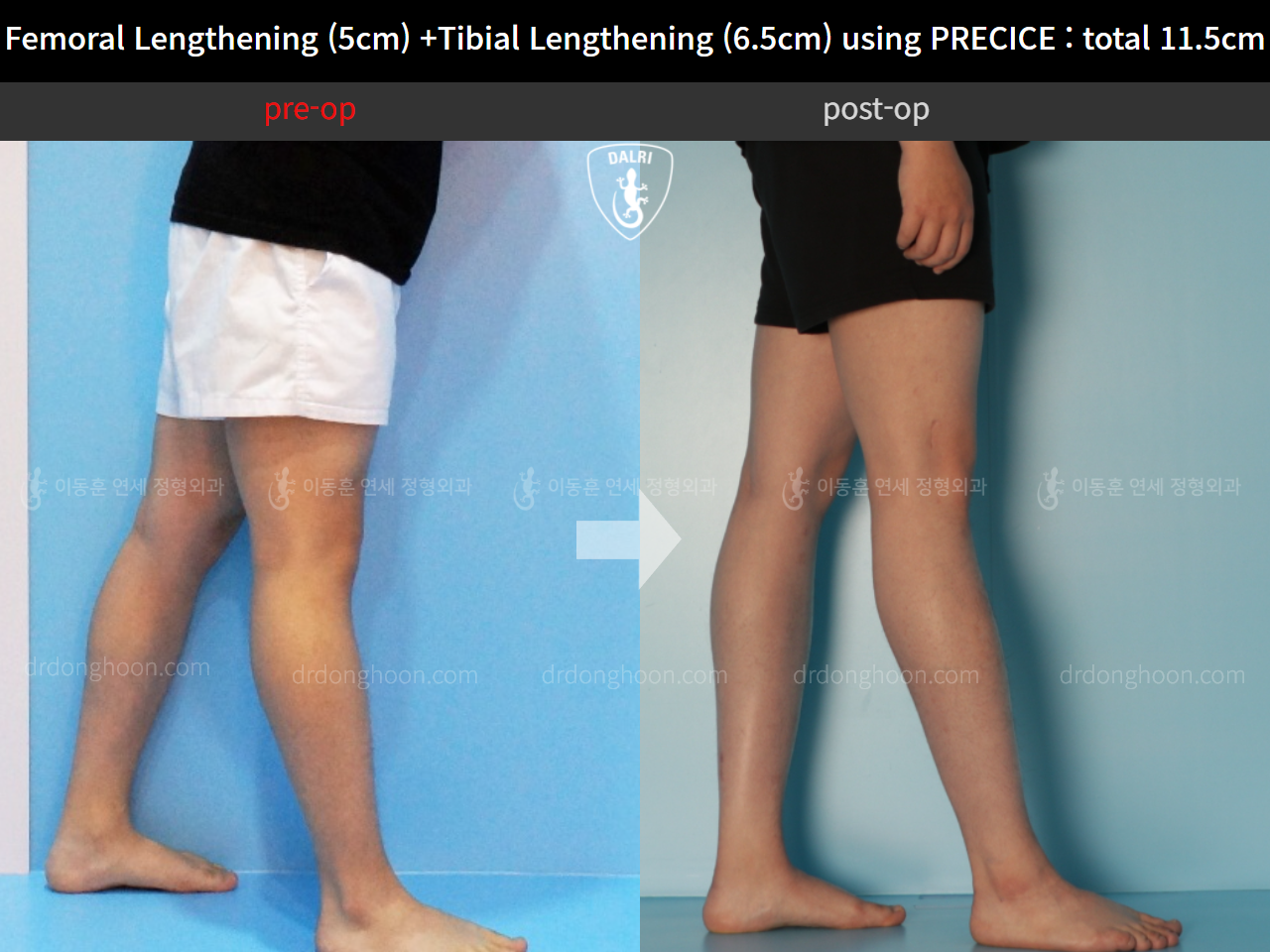 Before and after cll precice, case 11324647, image 9, Dr. Donghoon institute (DALRI)