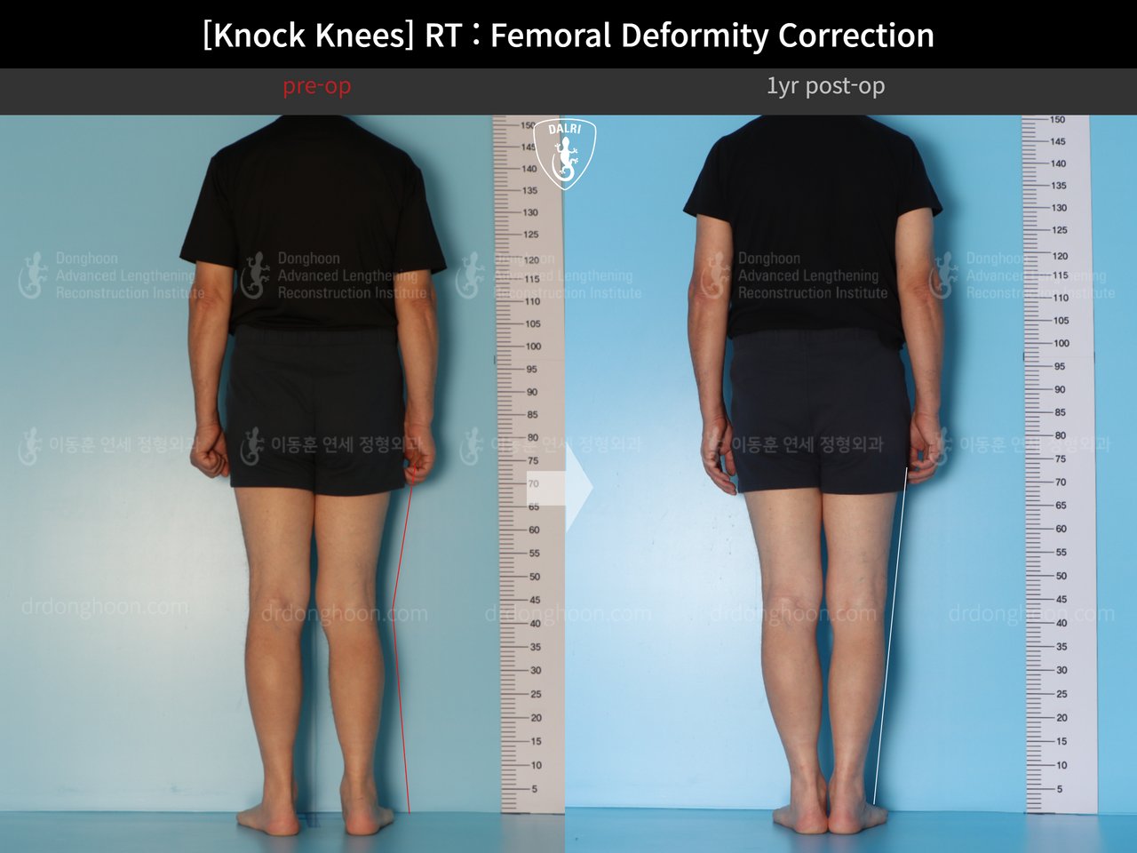 Before and after adult knock knees, case 14236357, image 2, Dr. Donghoon institute (DALRI)