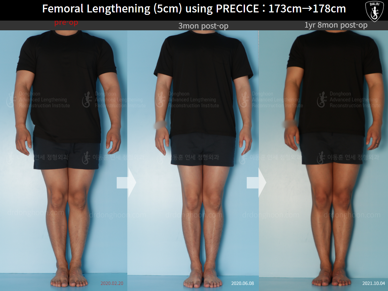 Before and after cll precice, case 21702609, image 1, Dr. Donghoon institute (DALRI)