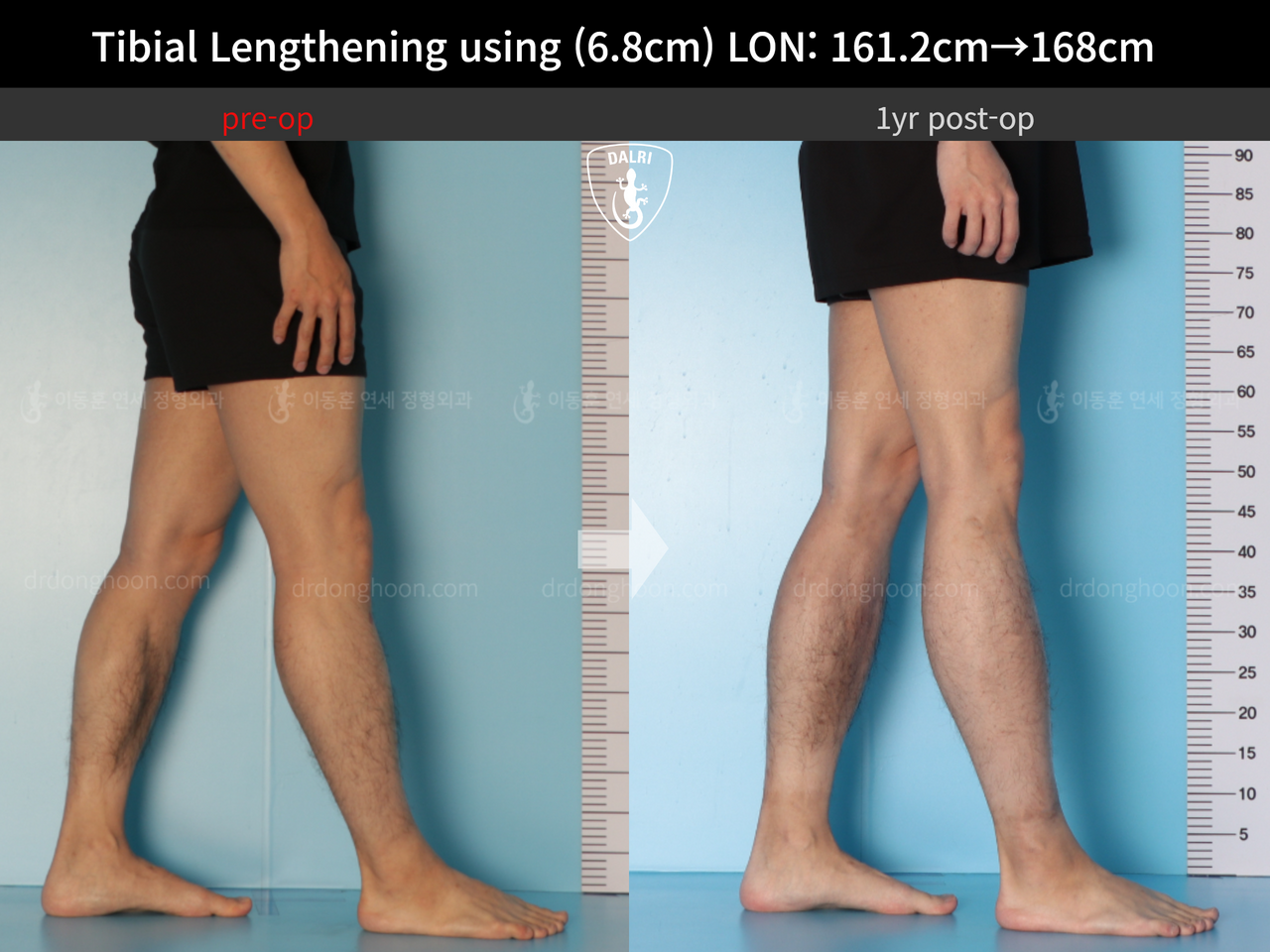 Before and after cll lon, case 13633878, image 10, Dr. Donghoon institute (DALRI)