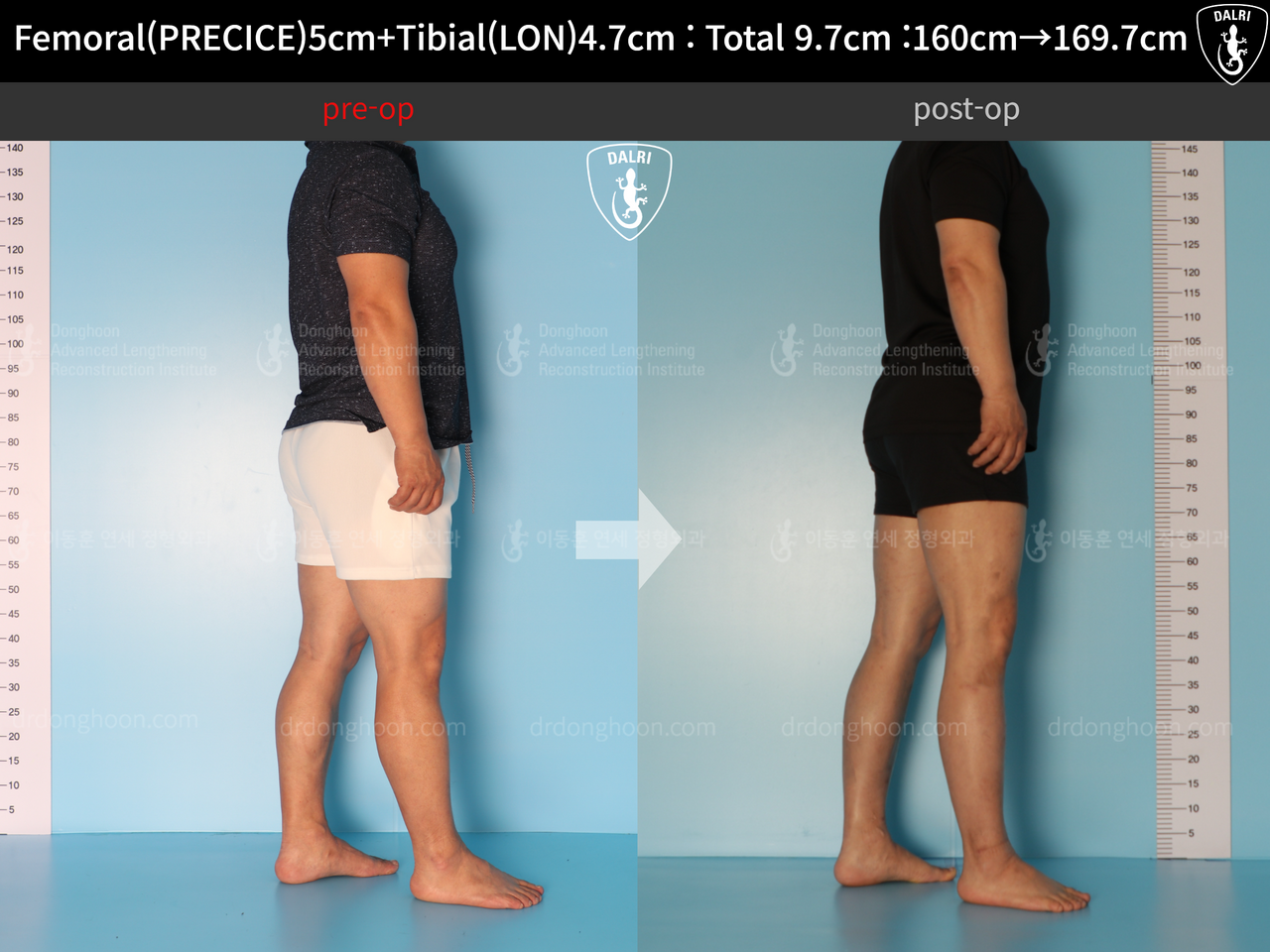 Before and after cll precice, case 7755066, image 5, Dr. Donghoon institute (DALRI)