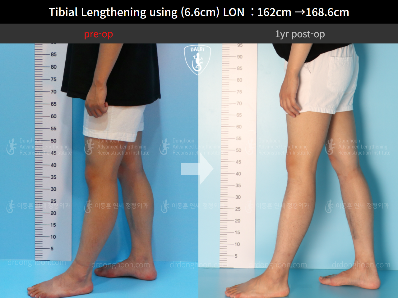 Before and after cll lon, case 4577769, image 8, Dr. Donghoon institute (DALRI)