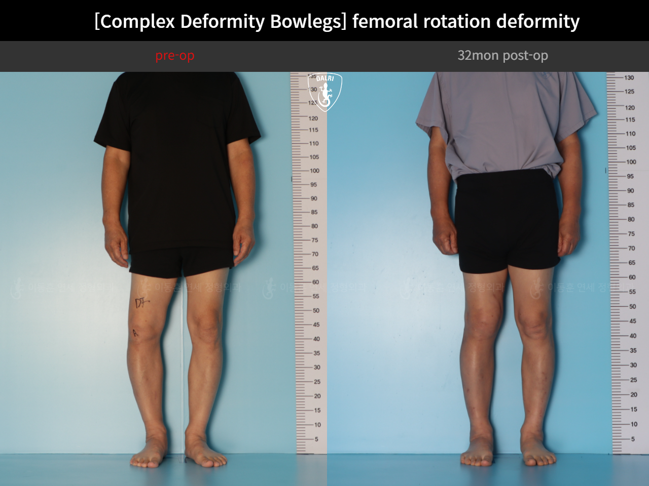 Before and after adult bowlegs, case 35242887, image 4, Dr. Donghoon institute (DALRI)