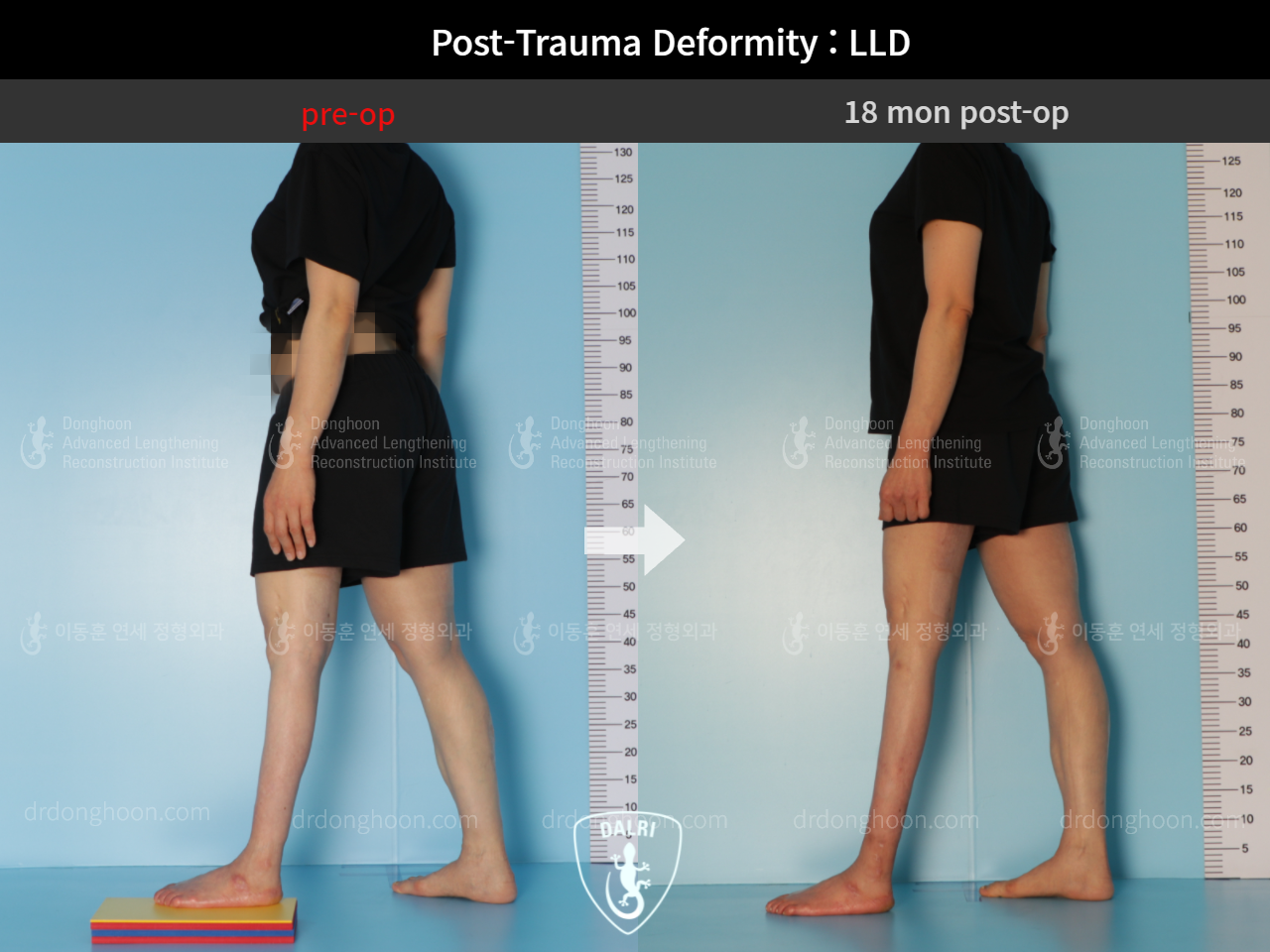 Before and after adult lld, case 9125304, image 3, Dr. Donghoon institute (DALRI)