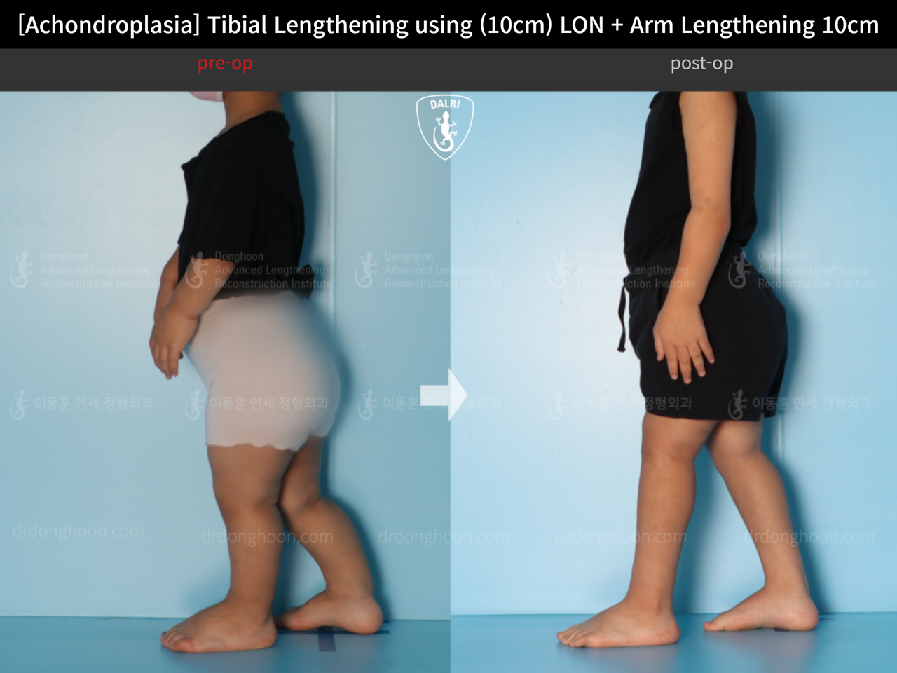 Before and after paediatric congenital condition, case 13864044, image 6, Dr. Donghoon institute (DALRI)