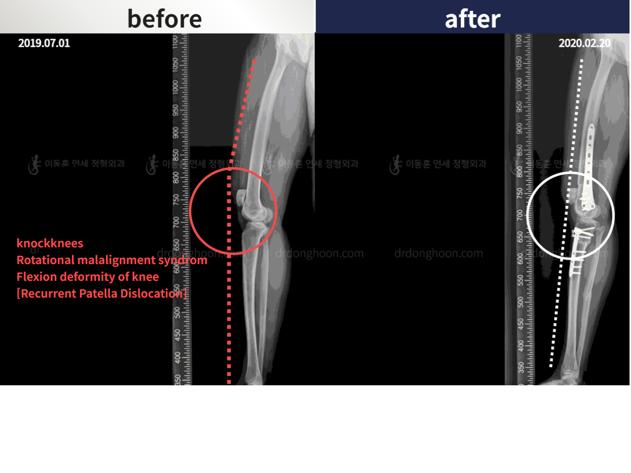 Before and after adult knock knees, case 4310881, image 2, Dr. Donghoon institute (DALRI)