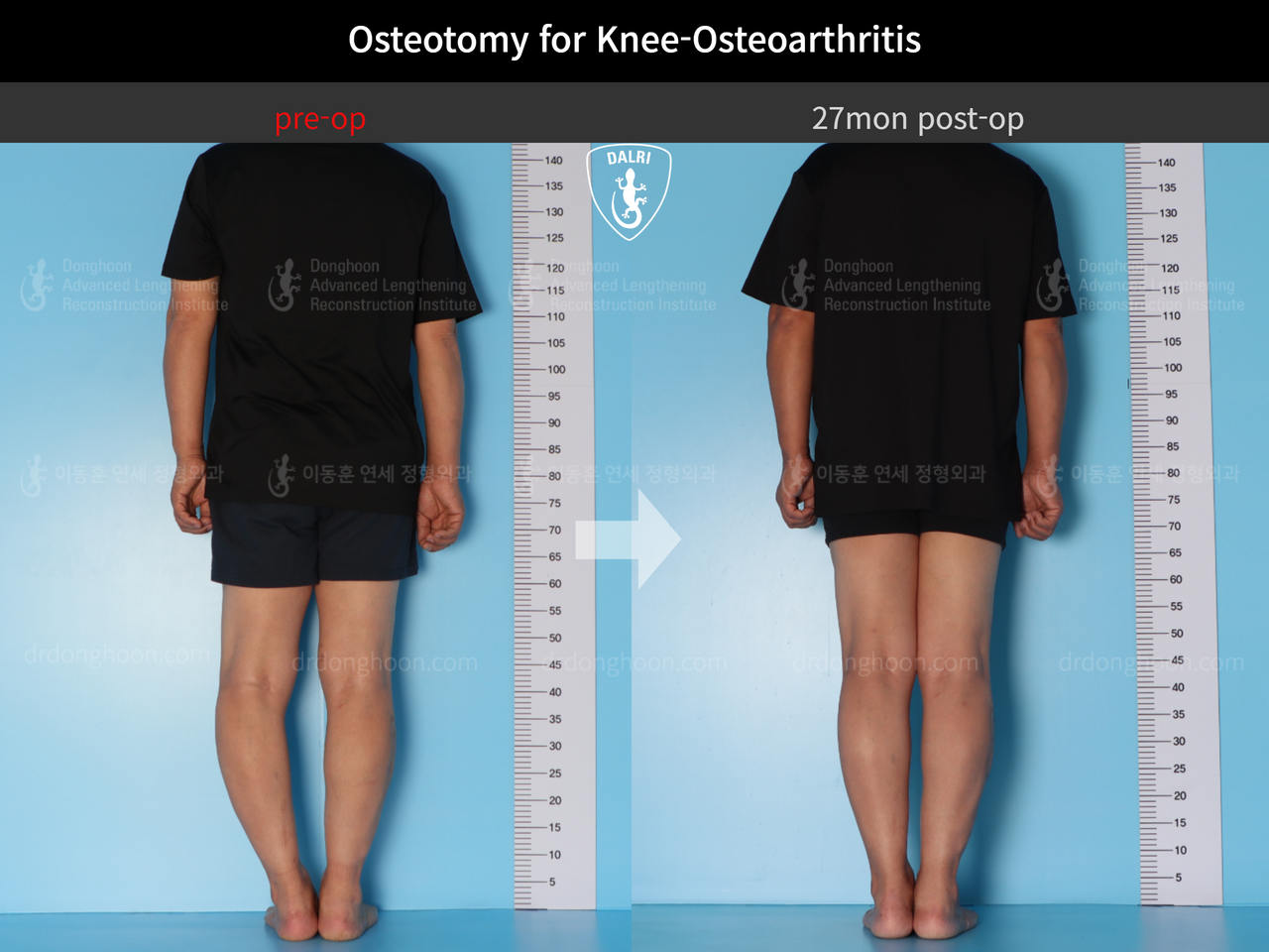 Before and after osteotomy for knee osteoarthritis, case 12535590, image 4, Dr. Donghoon institute (DALRI)