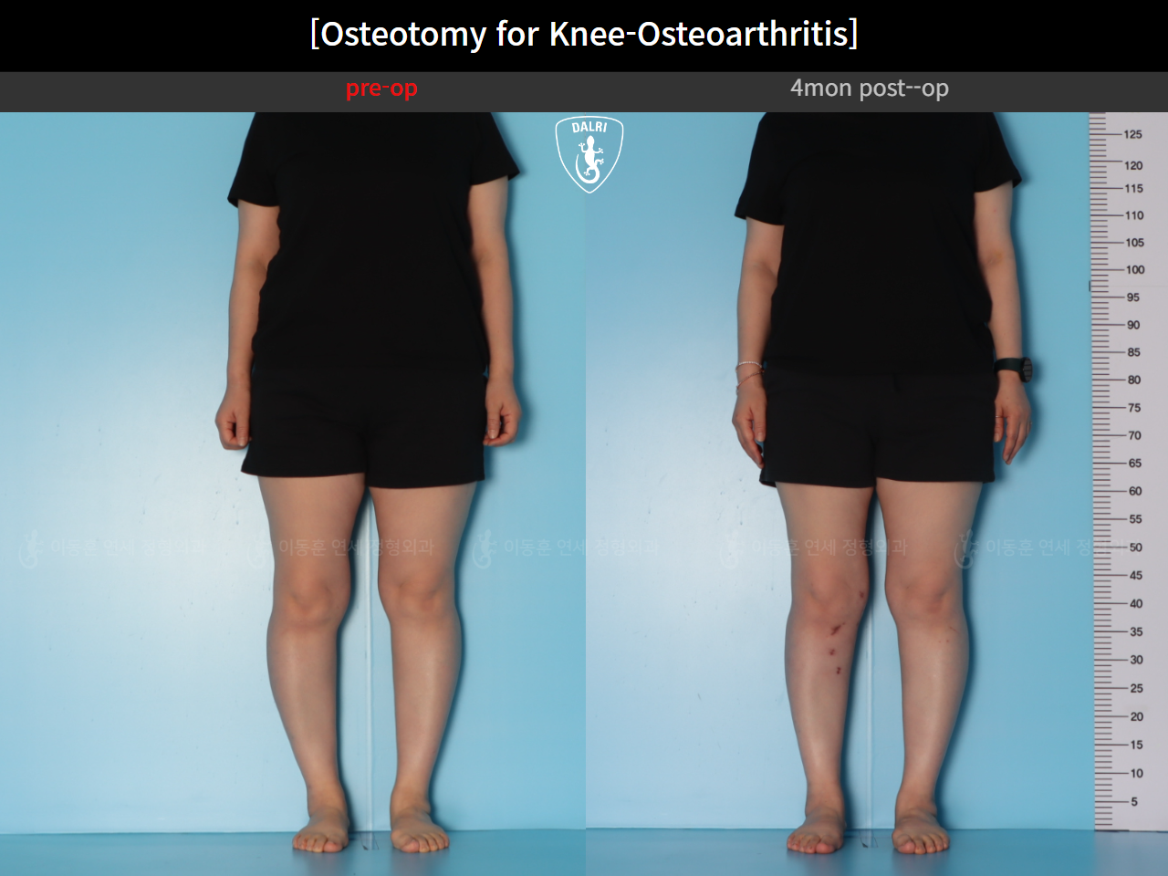Before and after osteotomy for knee osteoarthritis, case 39778471, image 3, Dr. Donghoon institute (DALRI)