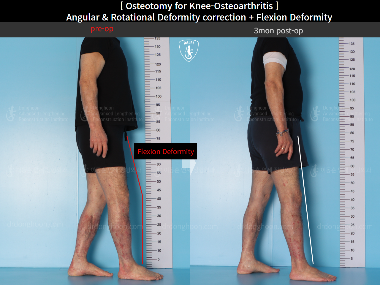 Before and after adult bowlegs, case 15362947, image 7, Dr. Donghoon institute (DALRI)