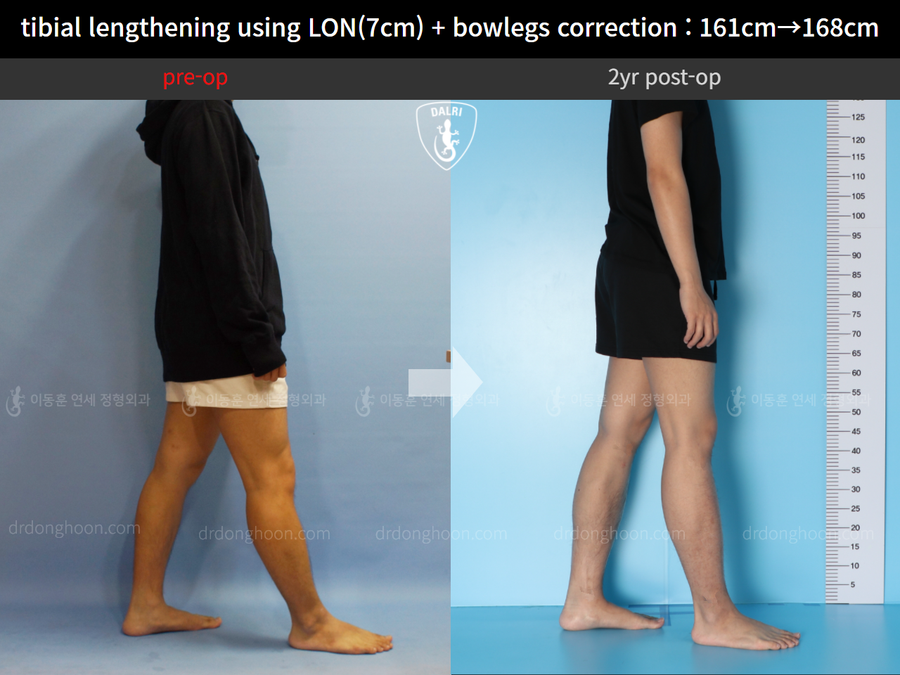Before and after cll + deformity correction, case 10400088, image 4, Dr. Donghoon institute (DALRI)