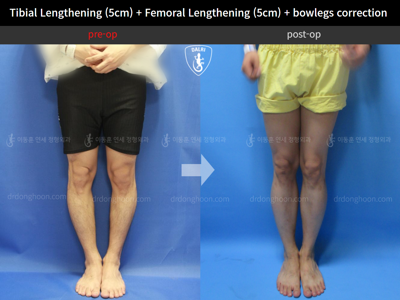 Before and after cll + deformity correction, case 4323174, image 3, Dr. Donghoon institute (DALRI)