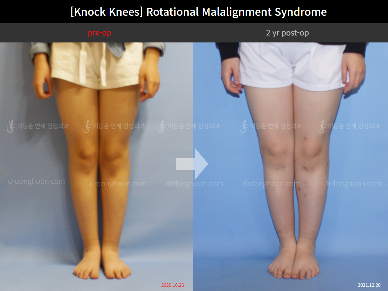 Before and after adult knock knees, case 9232717, image 5, Dr. Donghoon institute (DALRI)