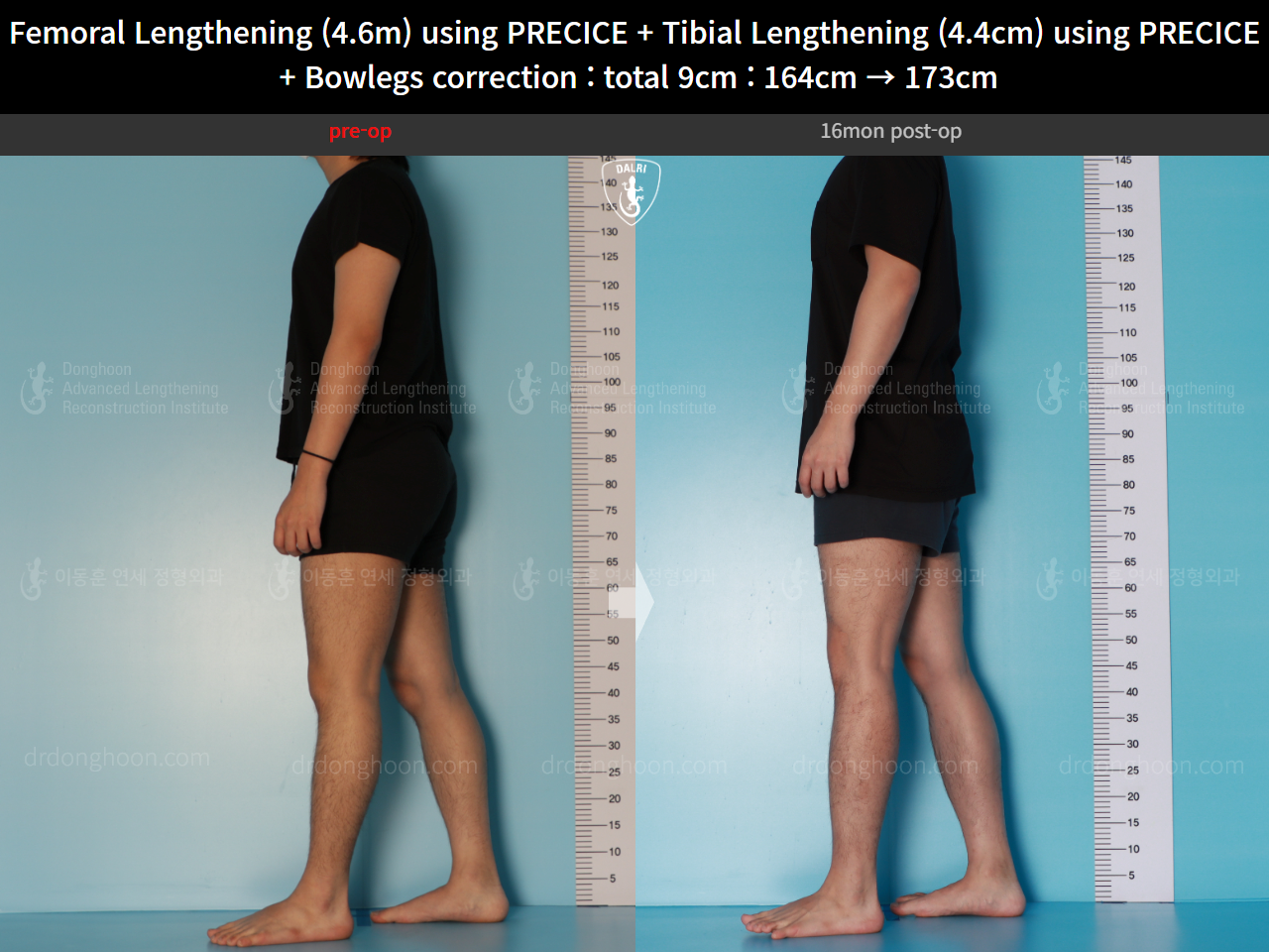 Before and after cll + deformity correction, case 16697522, image 7, Dr. Donghoon institute (DALRI)