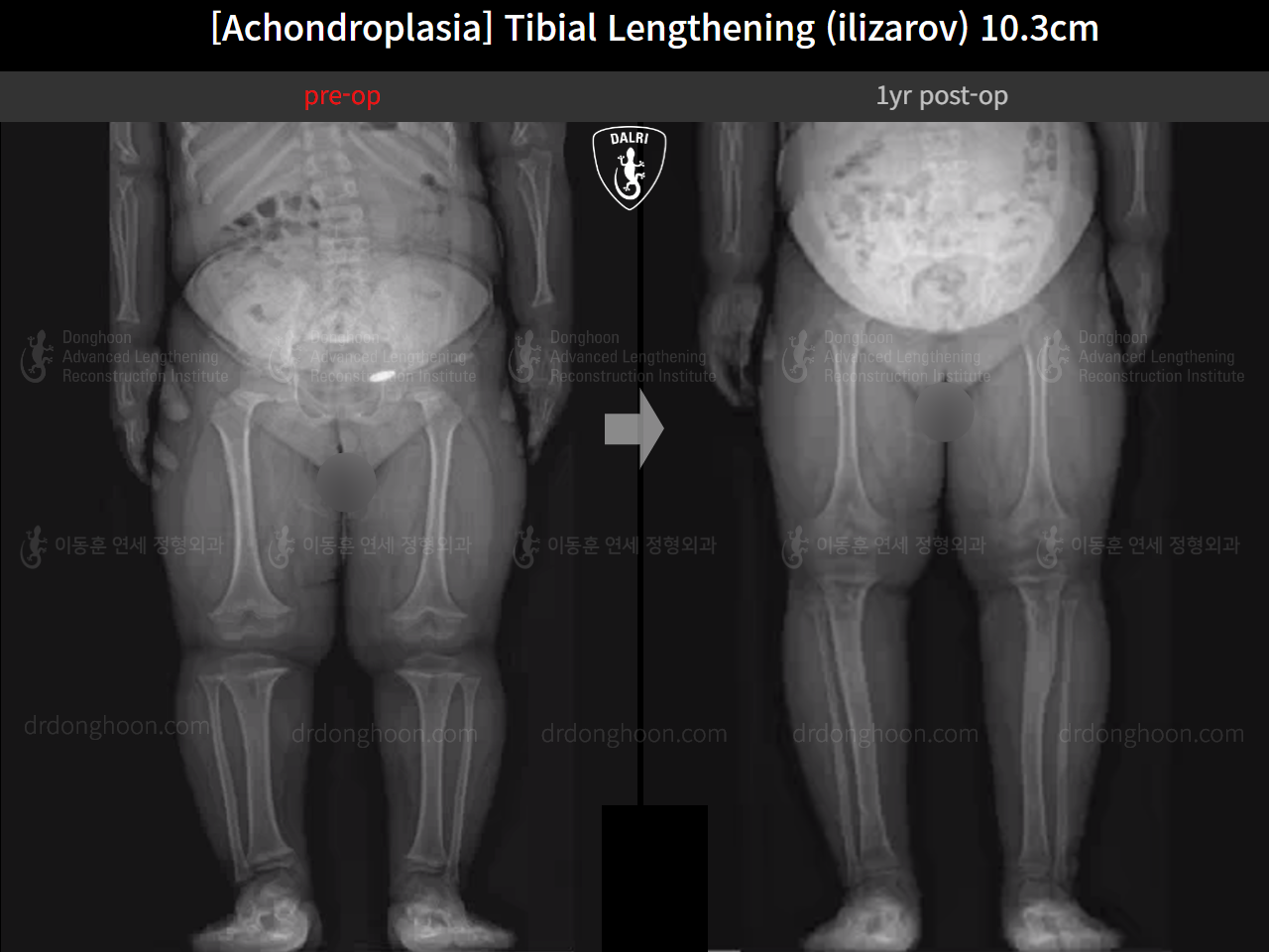 Before and after paediatric congenital condition, case 14507301, image 2, Dr. Donghoon institute (DALRI)