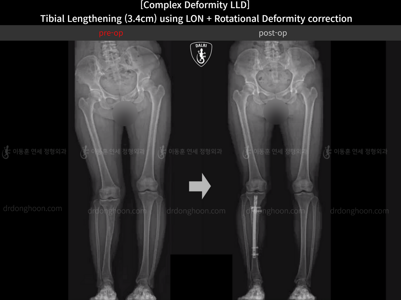 Before and after adult lld, case 14350311, image 8, Dr. Donghoon institute (DALRI)