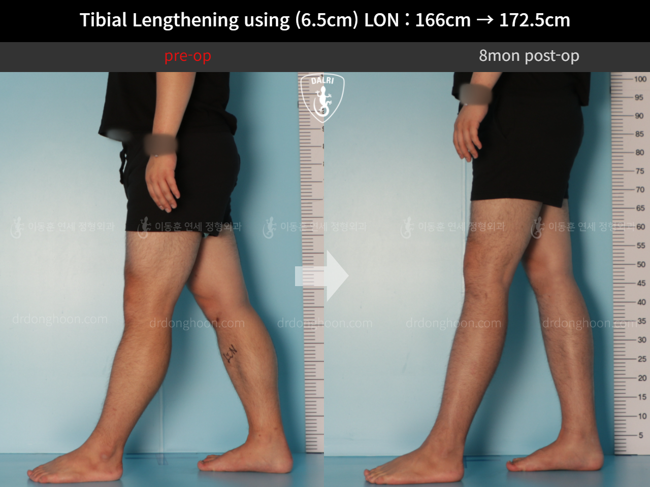 Before and after cll lon, case 11767706, image 6, Dr. Donghoon institute (DALRI)
