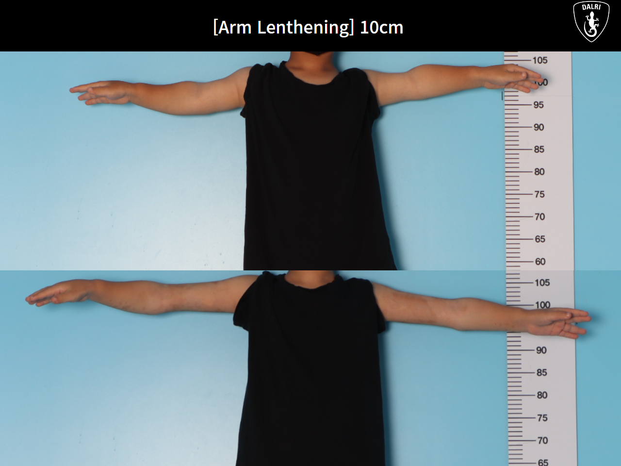 Before and after arm lengthening, case 31284248, image 1, Dr. Donghoon institute (DALRI)
