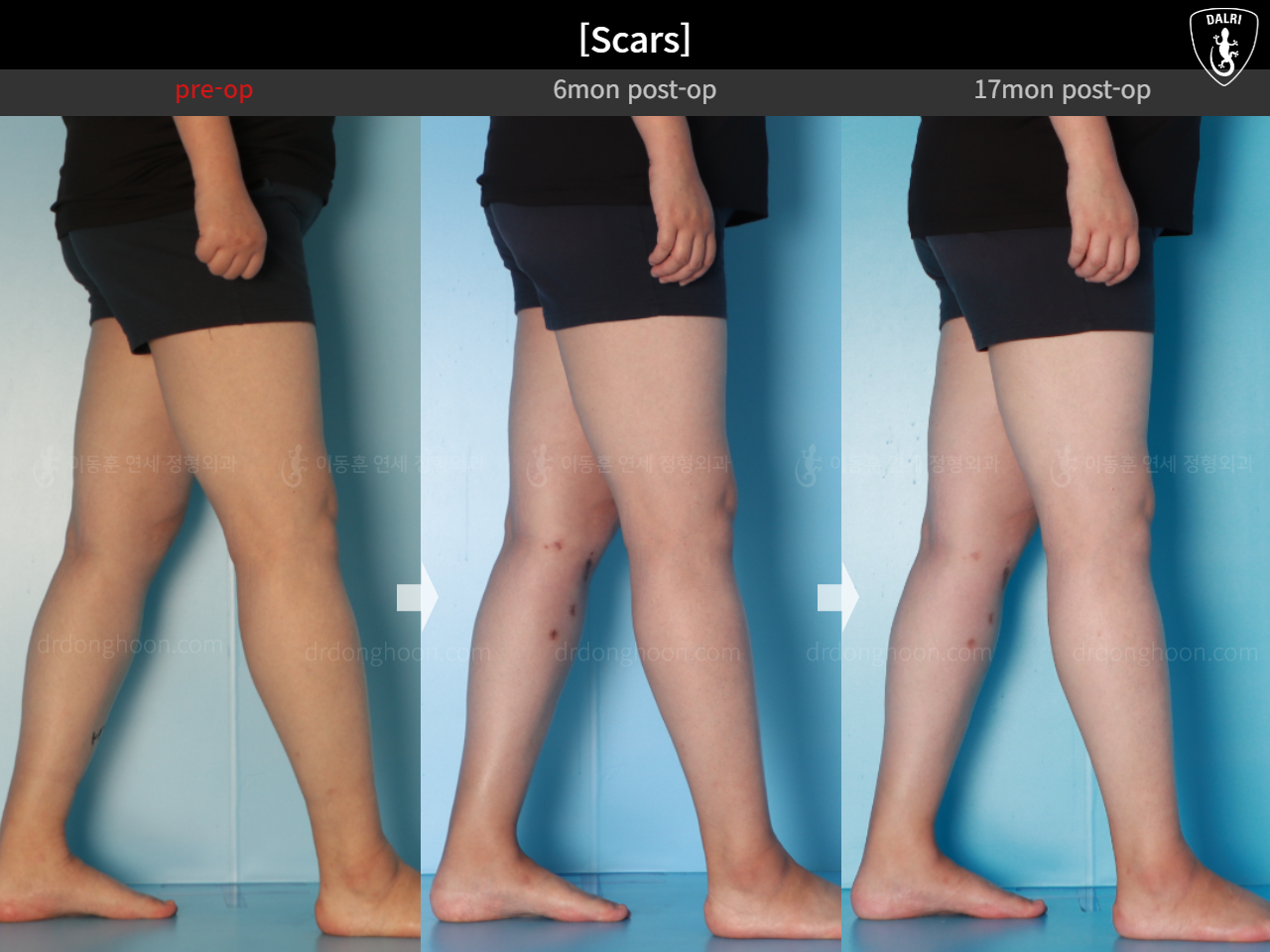 Before and after osteotomy for knee osteoarthritis, case 15944917, image 8, Dr. Donghoon institute (DALRI)