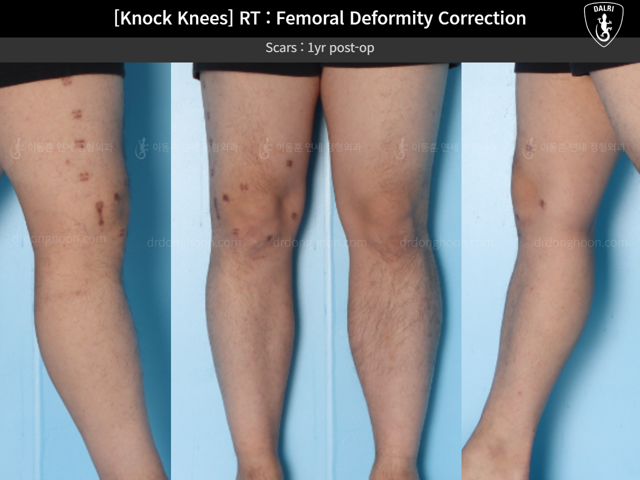 Before and after adult knock knees, case 15950751, image 8, Dr. Donghoon institute (DALRI)