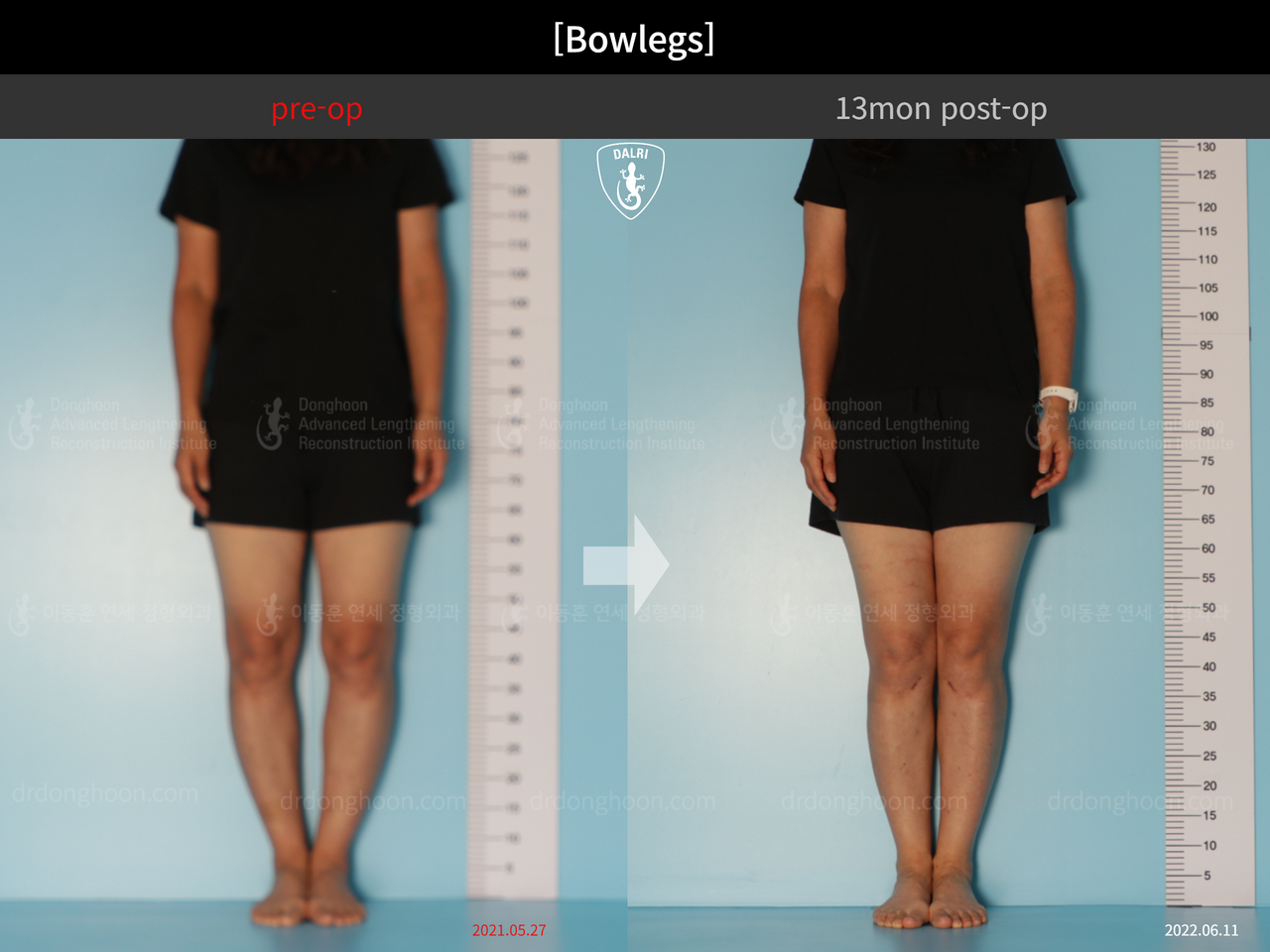 Before and after adult bowlegs, case 13223508, image 3, Dr. Donghoon institute (DALRI)