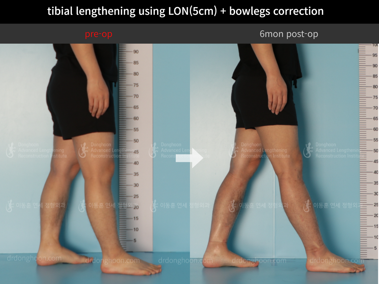 Before and after cll + deformity correction, case 11925306, image 7, Dr. Donghoon institute (DALRI)