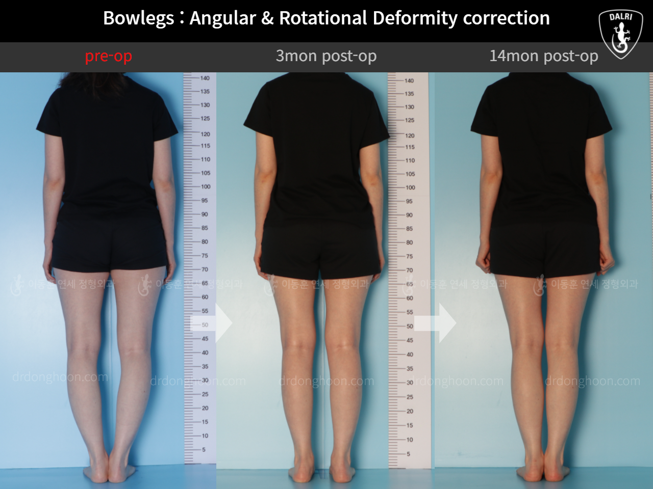 Before and after adult bowlegs, case 9557826, image 2, Dr. Donghoon institute (DALRI)