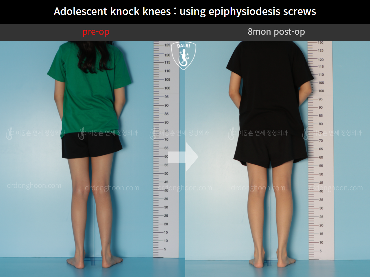 Before and after paediatric & adolescent knock knees, case 10451470, image 2, Dr. Donghoon institute (DALRI)