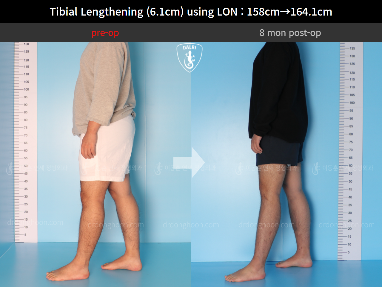 Before and after cll lon, case 4577743, image 4, Dr. Donghoon institute (DALRI)