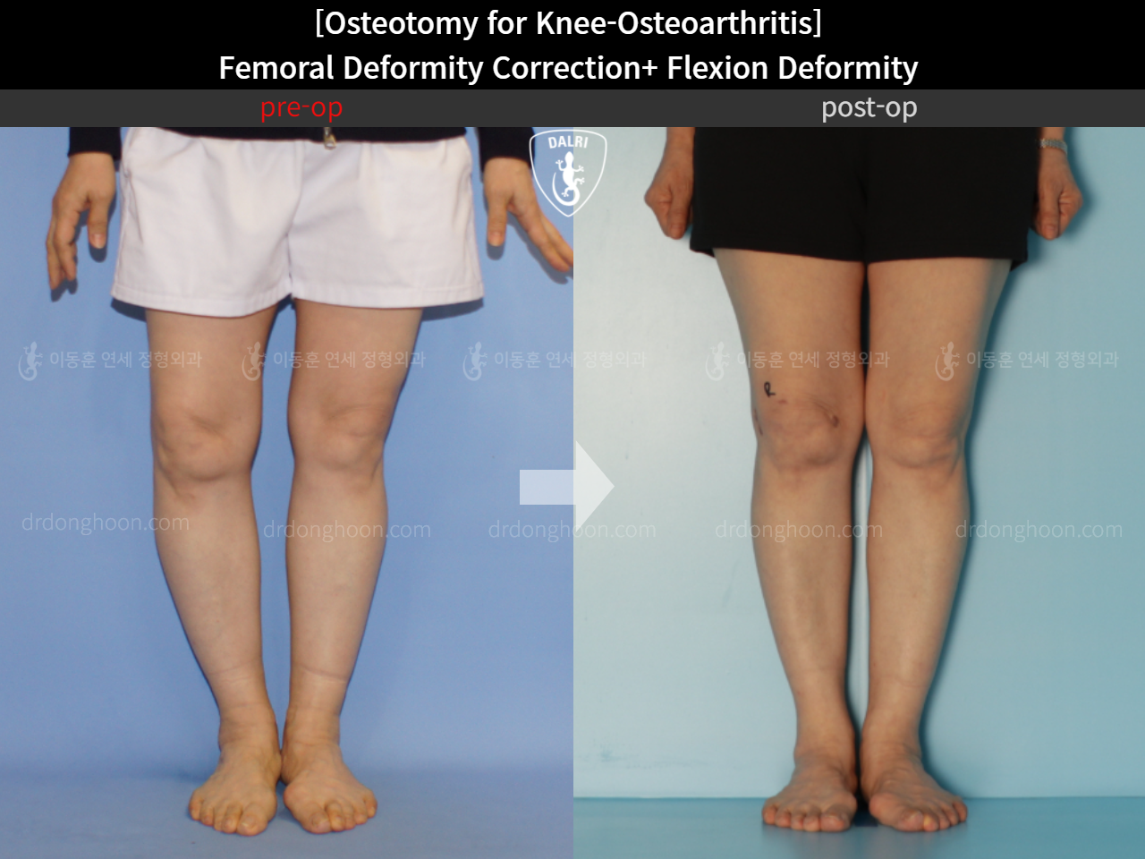 Before and after osteotomy for knee osteoarthritis, case 11380349, image 6, Dr. Donghoon institute (DALRI)