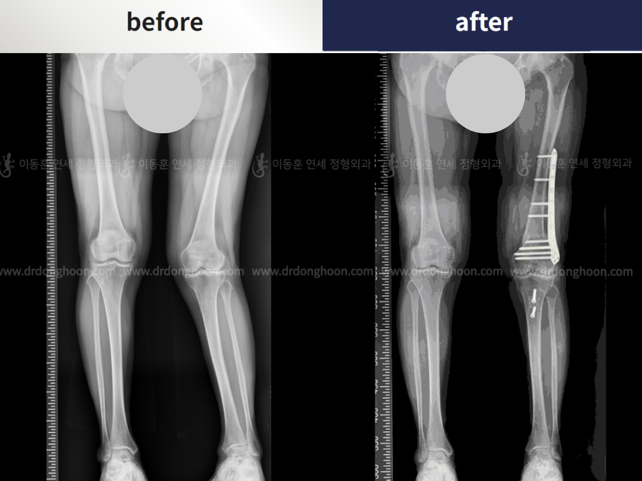 Before and after osteotomy for knee osteoarthritis, case 4306452, image 4, Dr. Donghoon institute (DALRI)