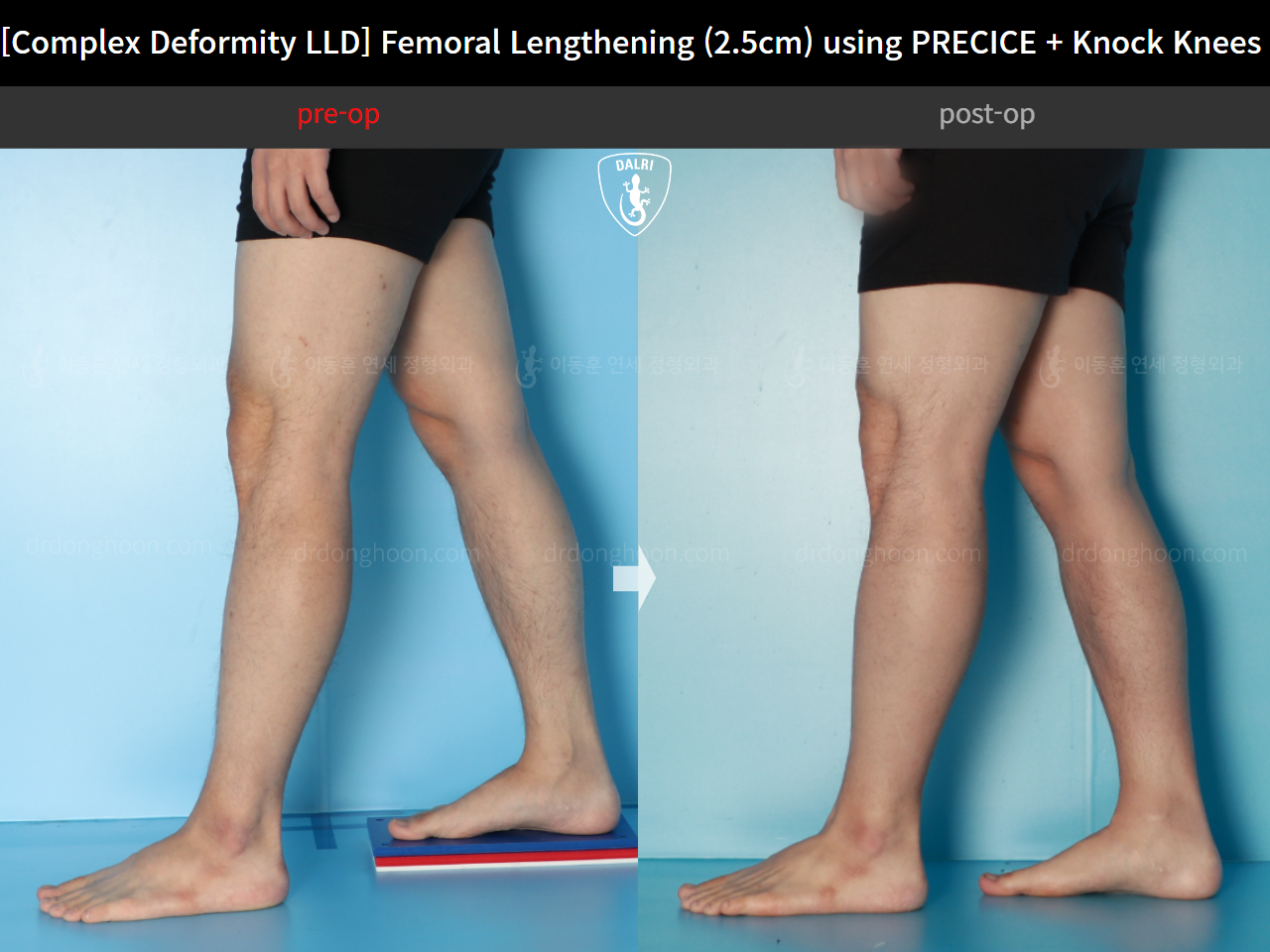 Before and after adult lld, case 17589131, image 8, Dr. Donghoon institute (DALRI)