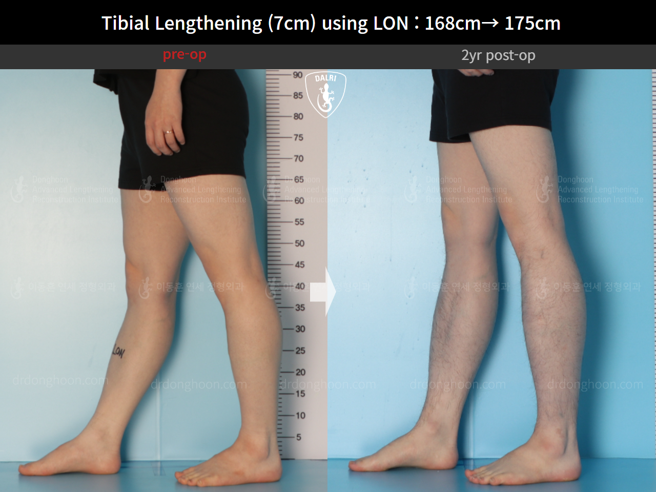 Before and after cll lon, case 14978046, image 10, Dr. Donghoon institute (DALRI)