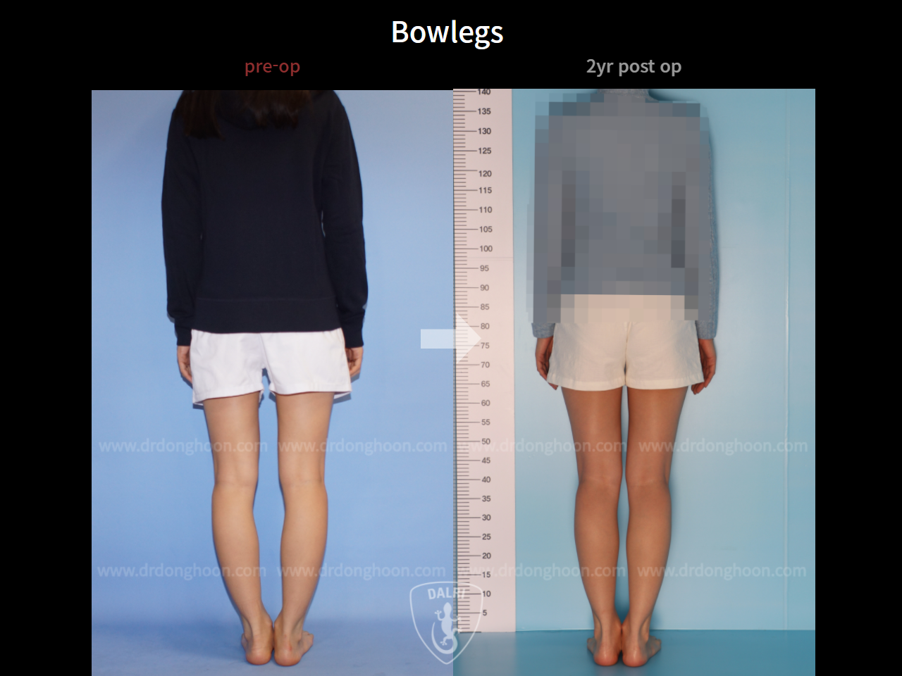 Before and after adult bowlegs, case 7651607, image 3, Dr. Donghoon institute (DALRI)