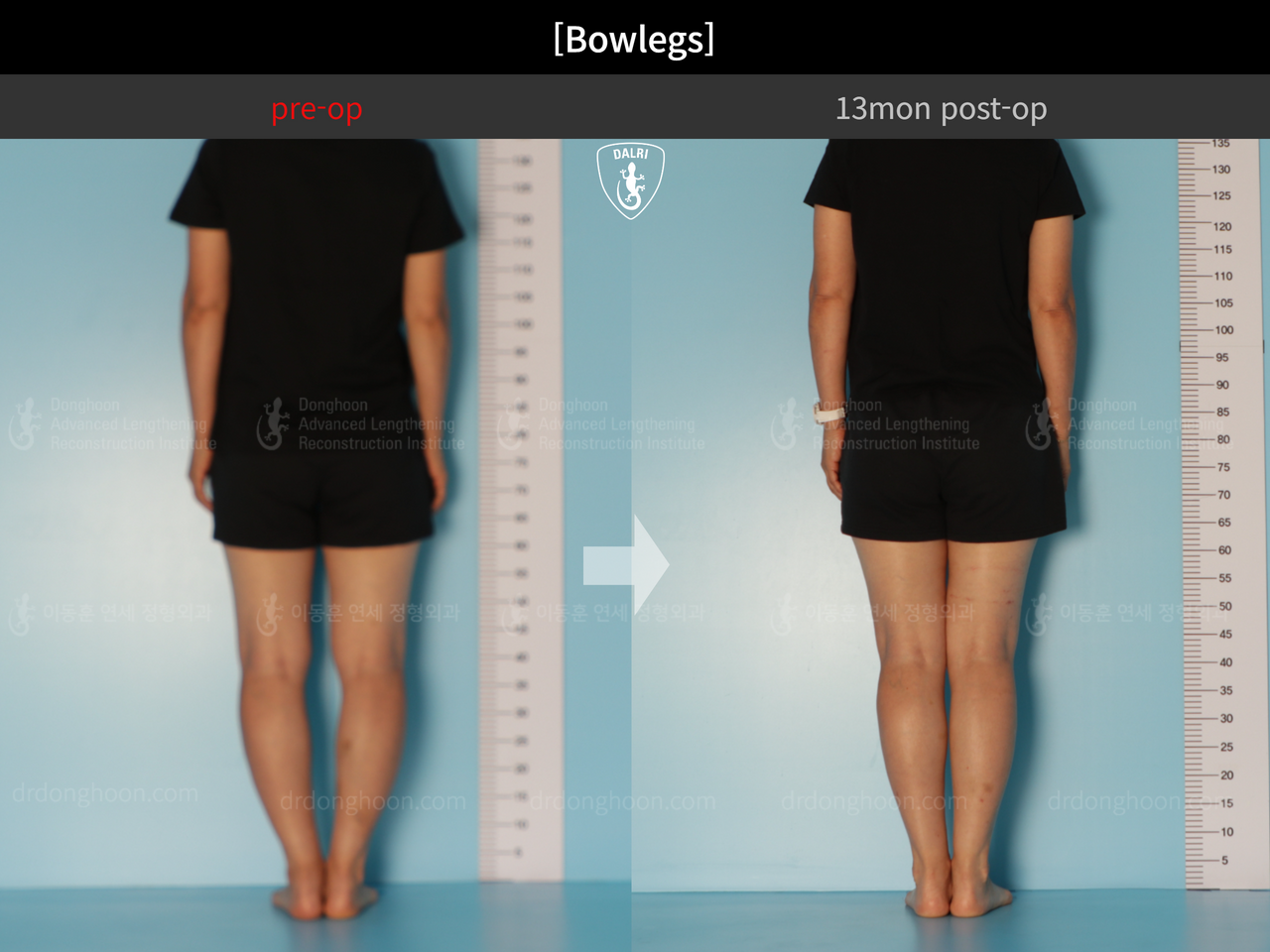 Before and after adult bowlegs, case 13223508, image 5, Dr. Donghoon institute (DALRI)