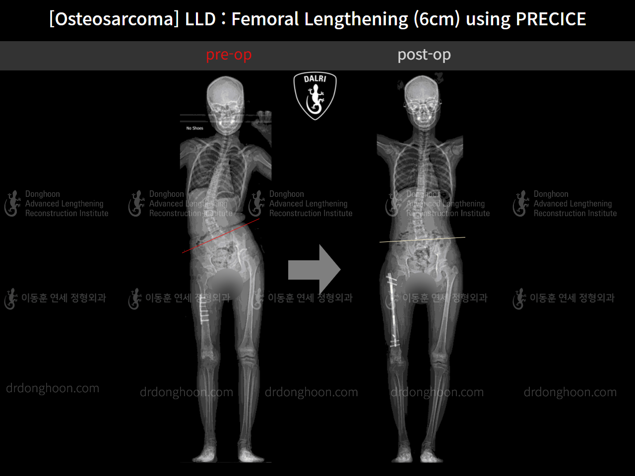 Before and after post-trauma deformity, case 11378057, image 6, Dr. Donghoon institute (DALRI)