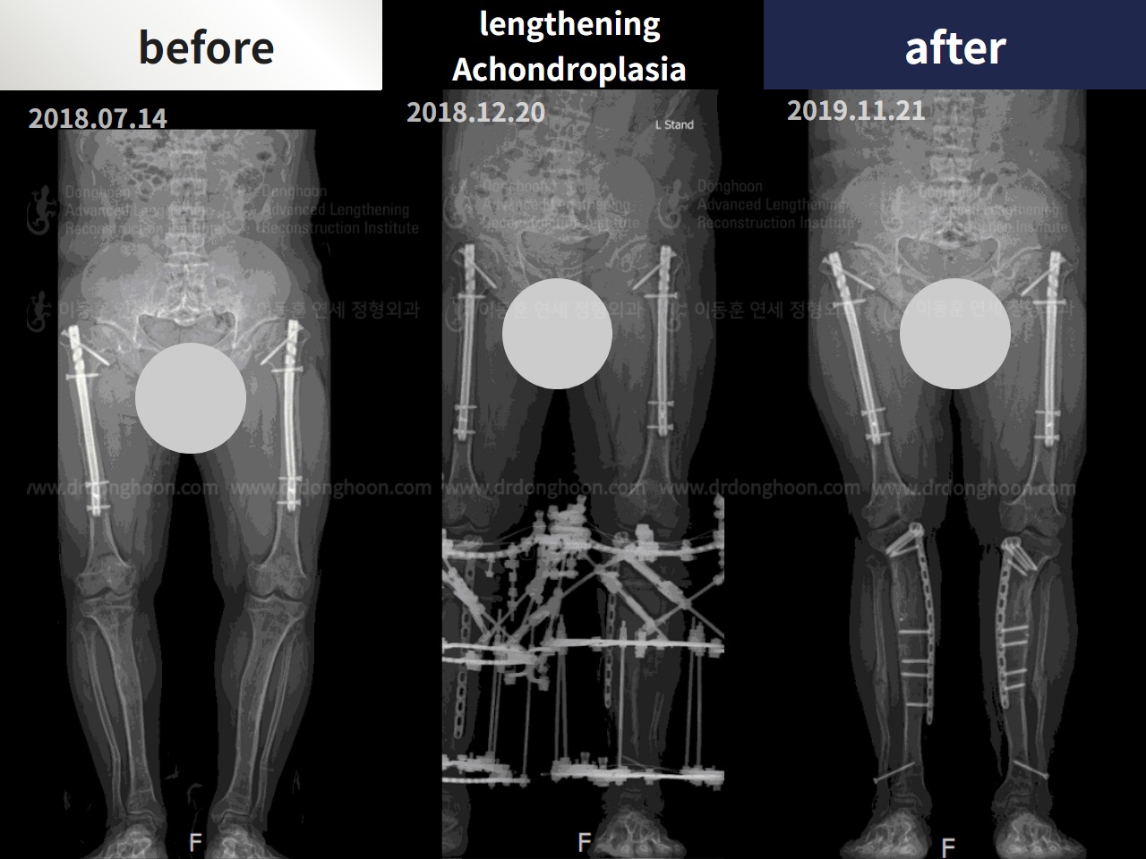Before and after congenital condition, case 4300020, image 3, Dr. Donghoon institute (DALRI)
