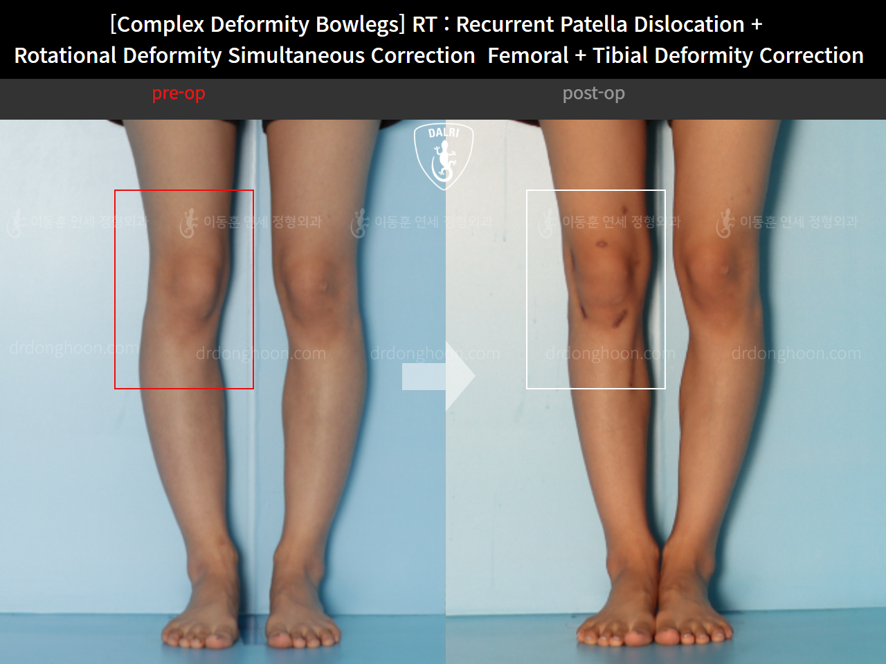 Before and after adult bowlegs, case 14960899, image 5, Dr. Donghoon institute (DALRI)