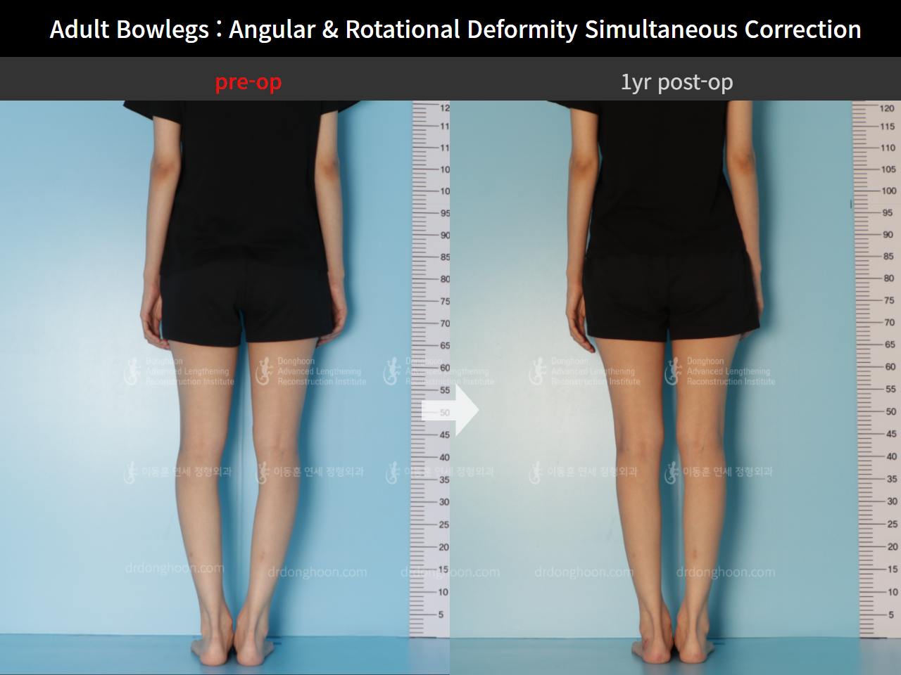 Before and after adult bowlegs, case 9058125, image 3, Dr. Donghoon institute (DALRI)