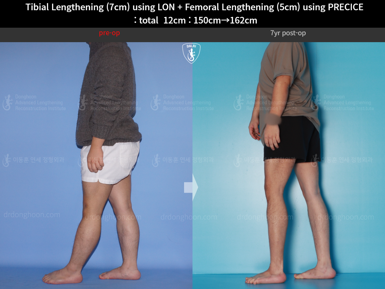 Before and after cll precice, case 16146445, image 8, Dr. Donghoon institute (DALRI)