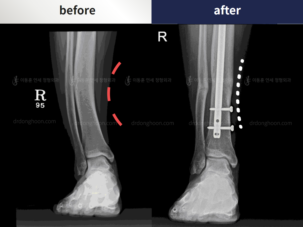Before and after foot & ankle deformity, case 4248027, image 4, Dr. Donghoon institute (DALRI)