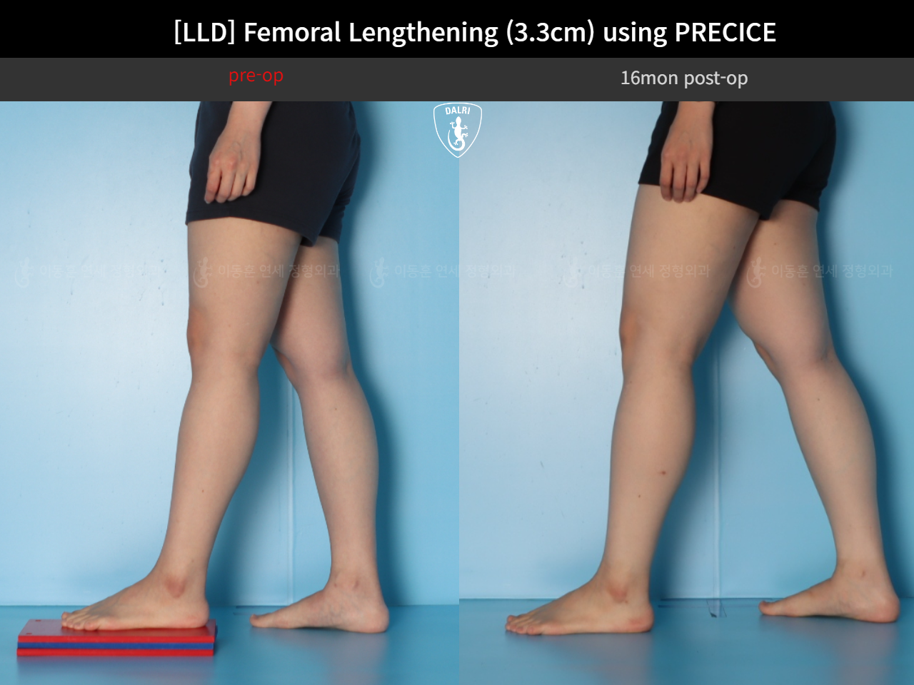 Before and after adult lld, case 125639660, image 7, Dr. Donghoon institute (DALRI)