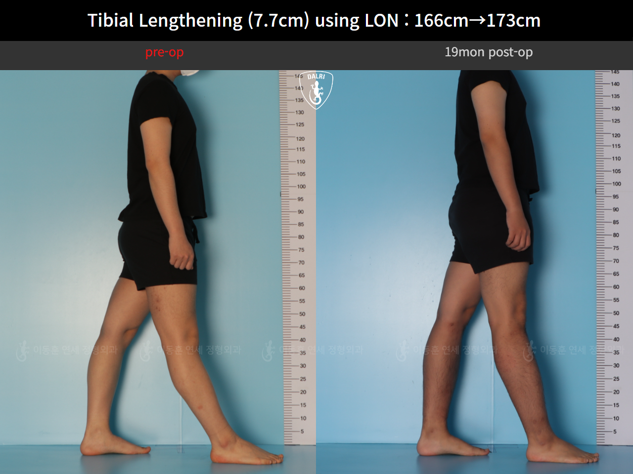 Before and after cll lon, case 126858222, image 4, Dr. Donghoon institute (DALRI)
