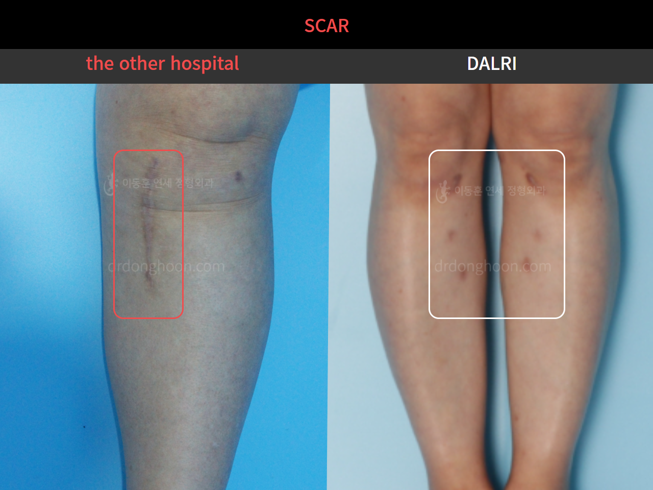 Before and after reoperation after deformity correction, case 4306331, image 3, Dr. Donghoon institute (DALRI)