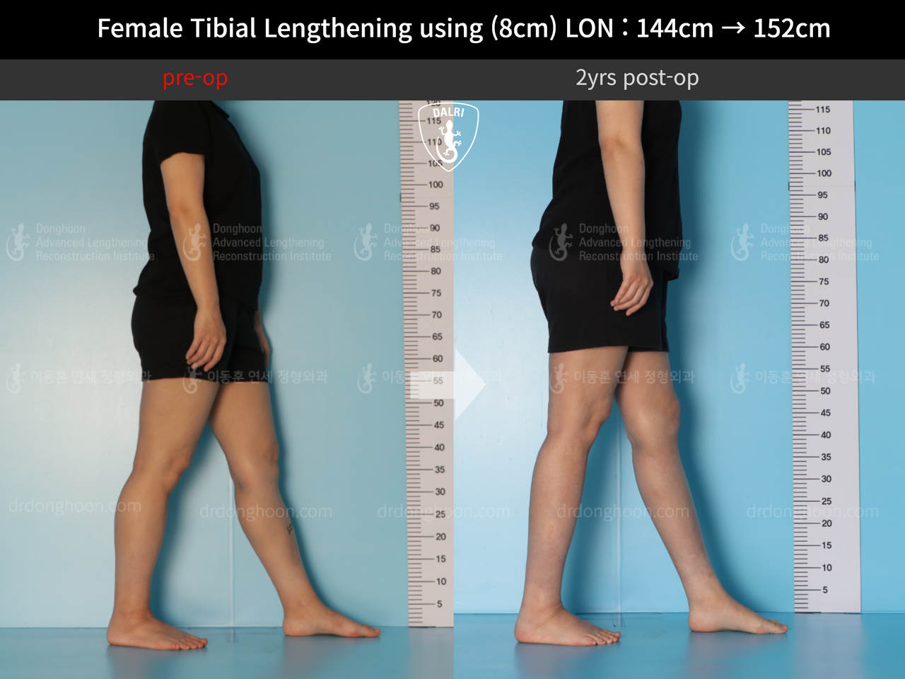 Before and after cll lon, case 12855676, image 4, Dr. Donghoon institute (DALRI)