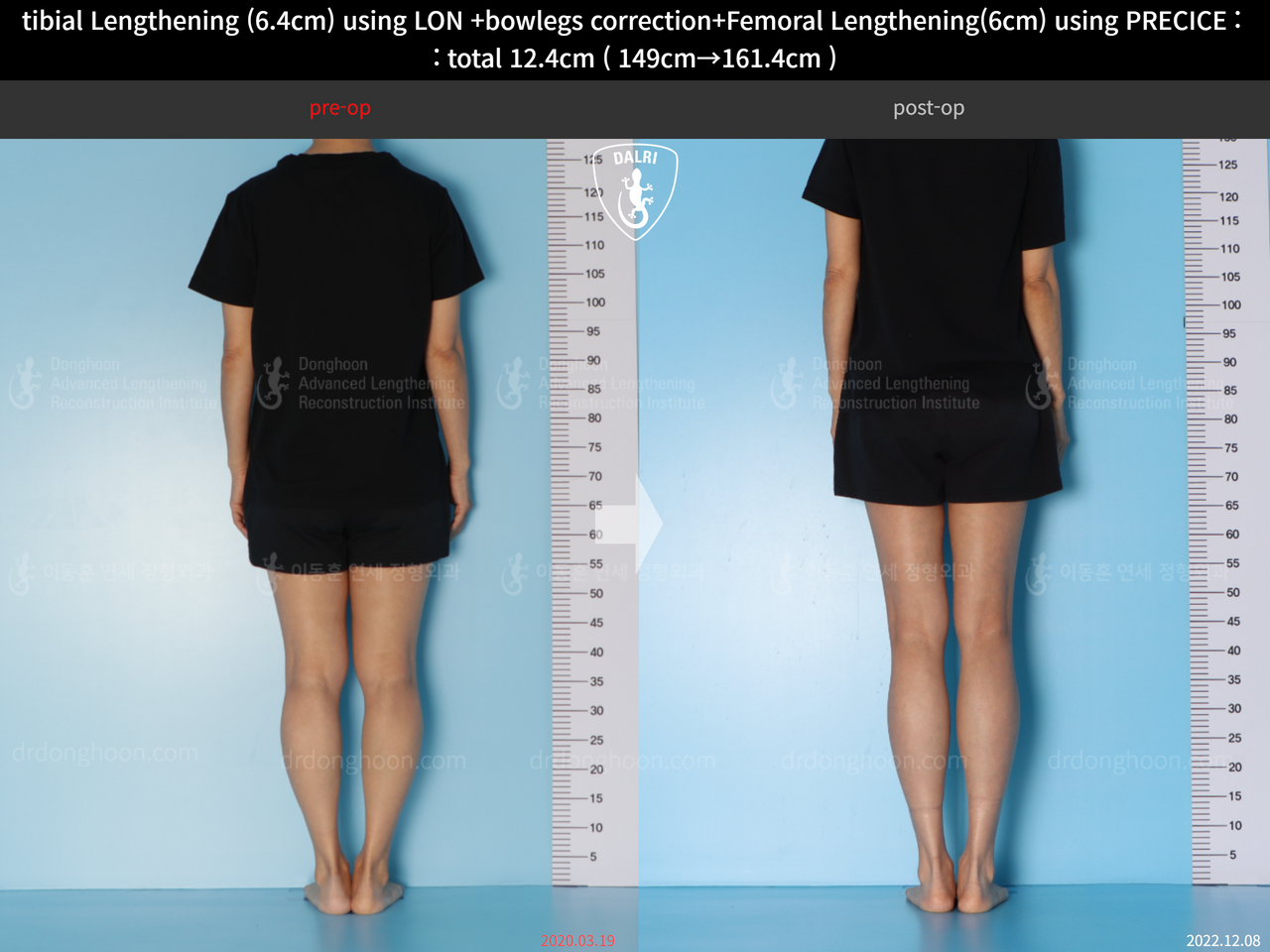 Before and after cll + deformity correction, case 13696242, image 6, Dr. Donghoon institute (DALRI)