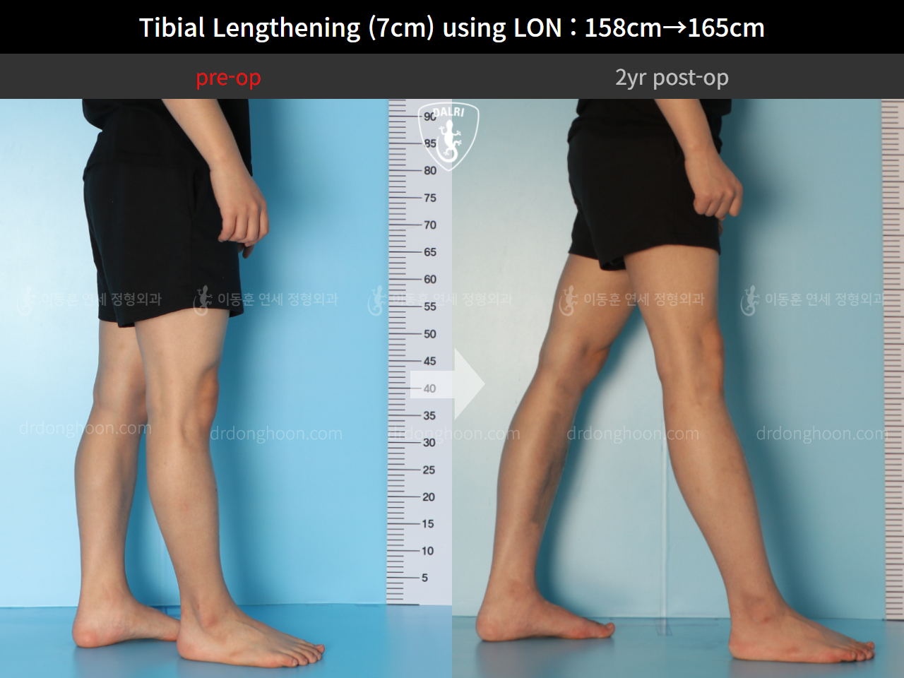 Before and after cll lon, case 9325768, image 7, Dr. Donghoon institute (DALRI)