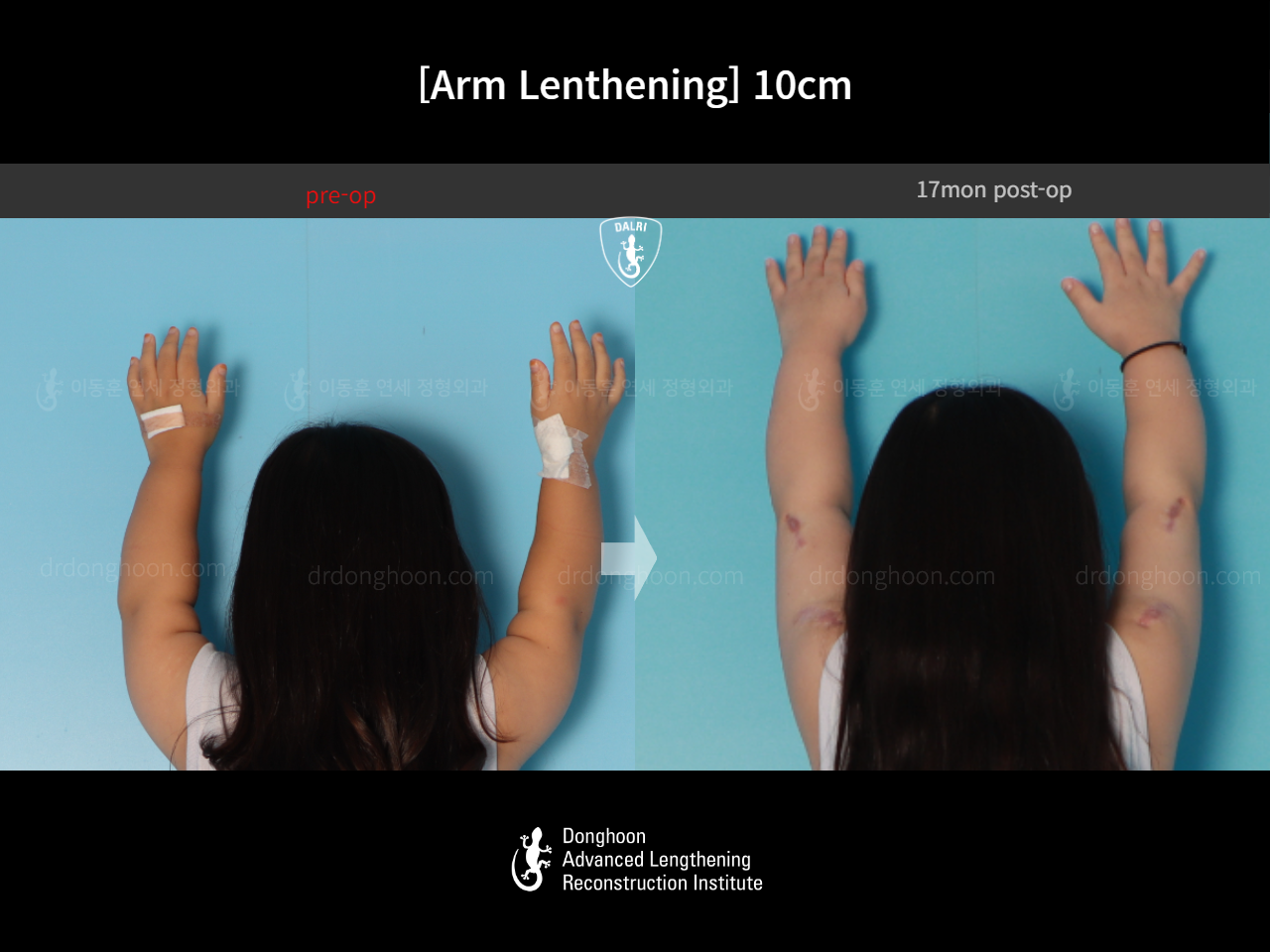 Before and after arm lengthening, case 17924395, image 5, Dr. Donghoon institute (DALRI)